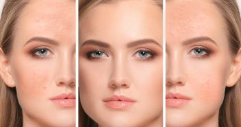 Rodan & Fields presentará una investigación sobre acné en adolescentes